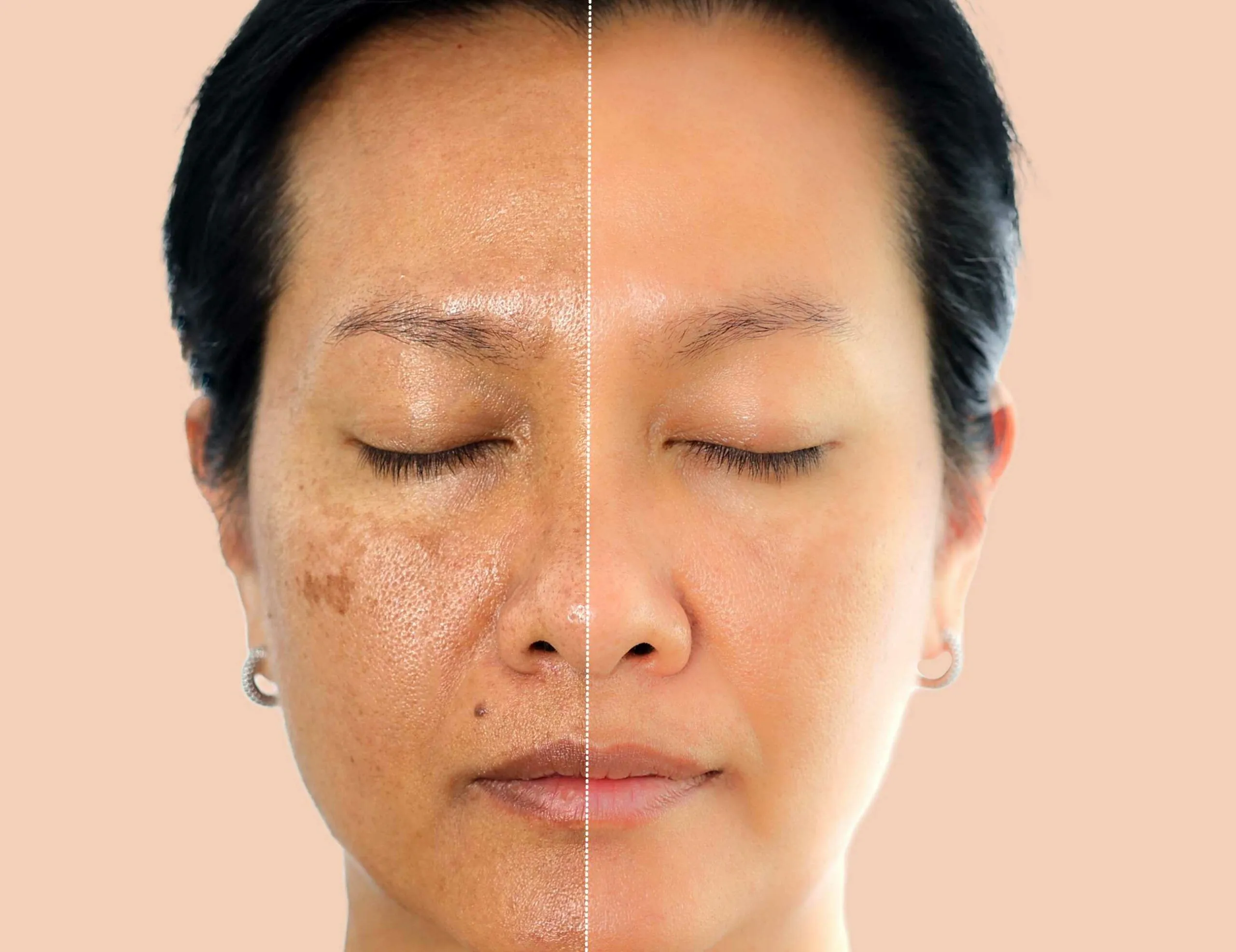 pigmentation 1 scaled 1